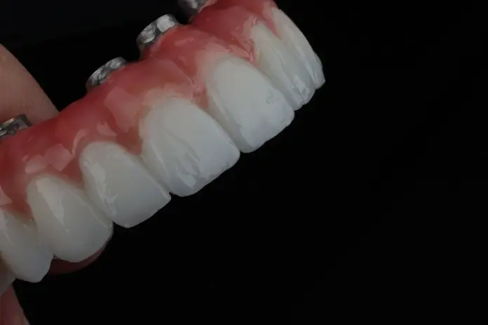 Upper jaw All-on-4 dental implants with visible screws for implant attachment, produced in Dentelli Split Croatia