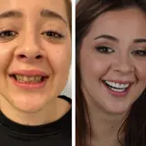 Smile Restoration in Dentelli in Split with Implants and veneers