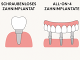 Schraubenlose Zahnimplantate vs All-on-4