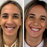 Before and After Dental Implants and Veneers
