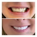 Beautiful teeth with All-on-4 implants