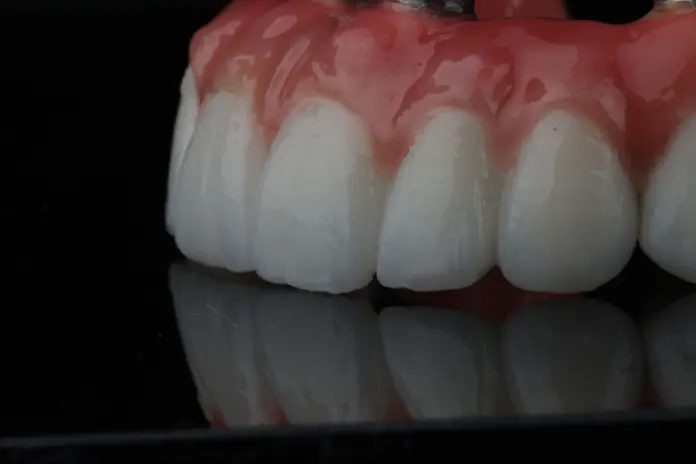 Close-up of Dentelli All-on-4 implant-supported prosthetic teeth with natural gum detail